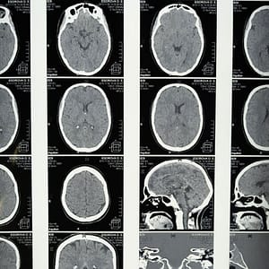 Traumatic Brain Injuries
